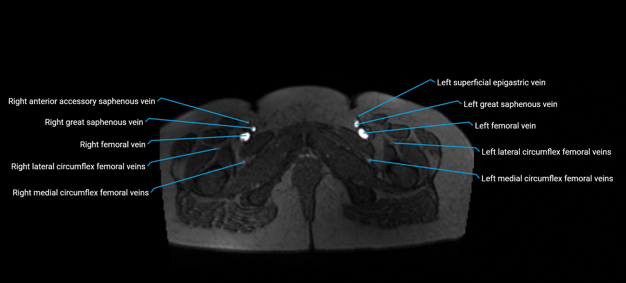 MRV abdomen pelvis & lower limb axial cross sectional anatomy labelled MRI image 198 (1).webp